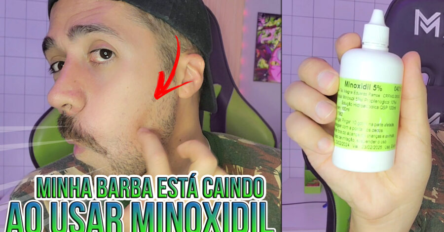 😭 COMECEI A USAR MINOXIDIL NA BARBA E ELA COMEÇOU A CAIR
